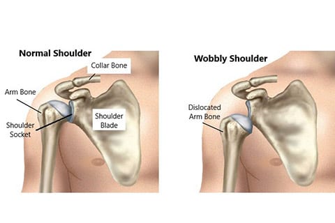 Shoulder-instabiliy