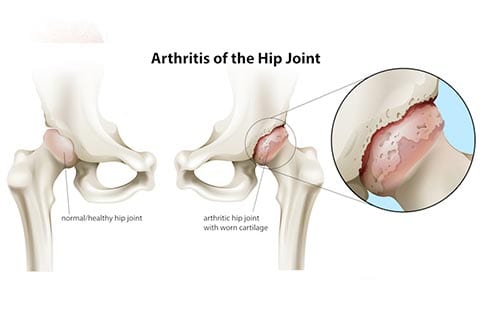 Hip-Osteoarthritis