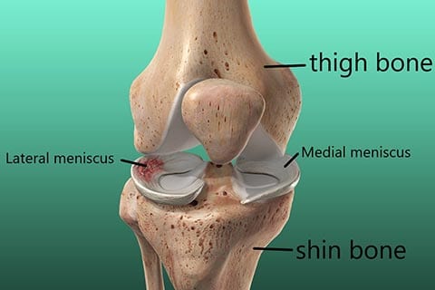 meniscus-injury-photo